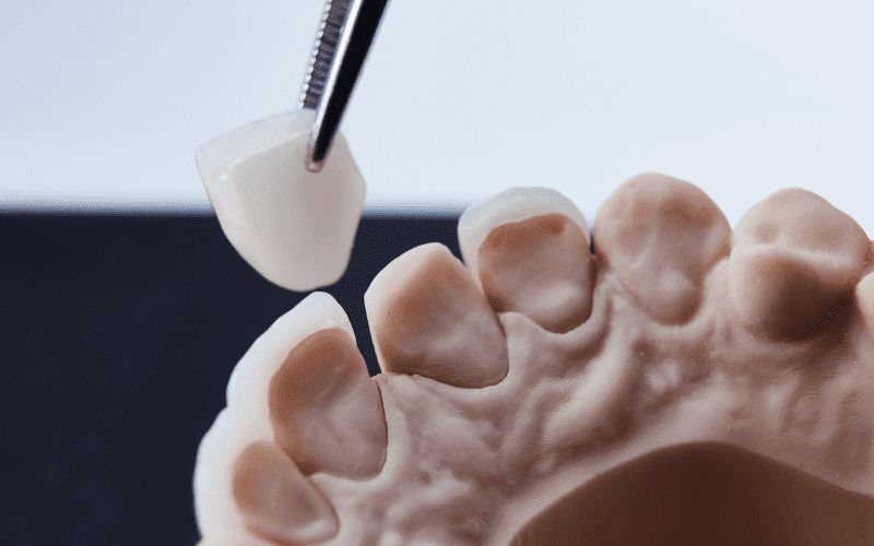 Dental Crown