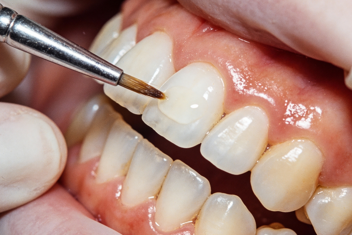 porcelain-veneers-in-Cedar-Grove