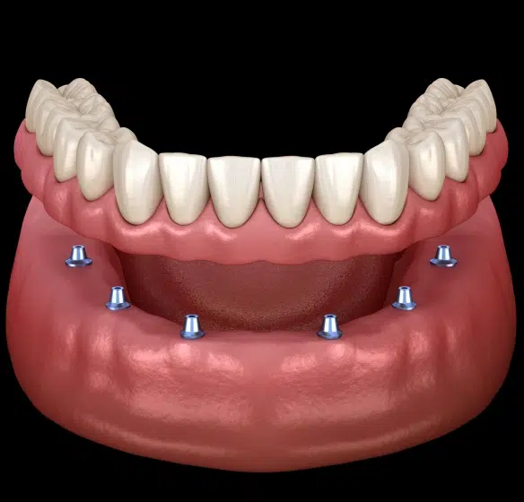 A Time-Tested Way to Replace Missing Teeth