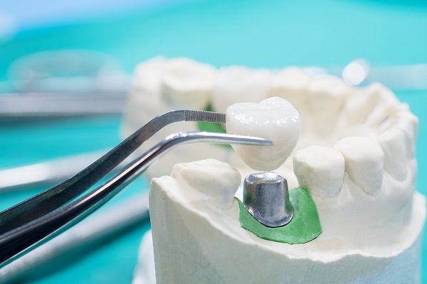 What To Do When Your Dental Crown Falls Out