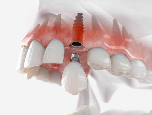 A Procedure Guide To Getting A Dental Implant