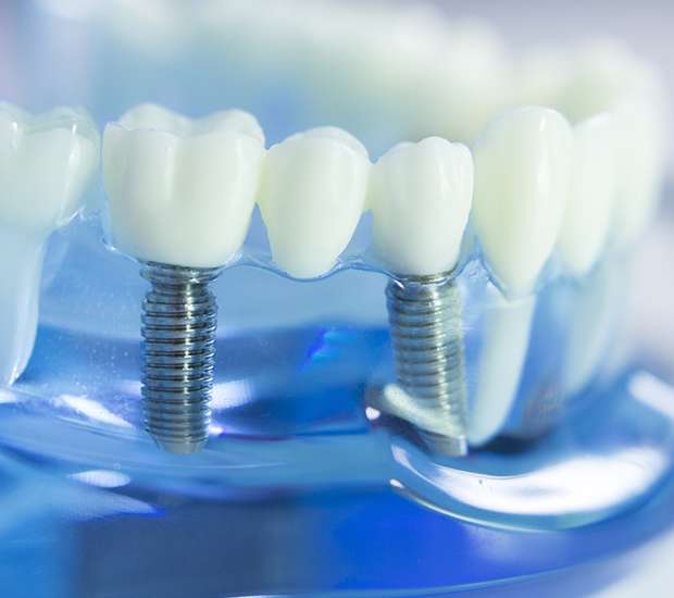 Cedar Grove Dental Implants